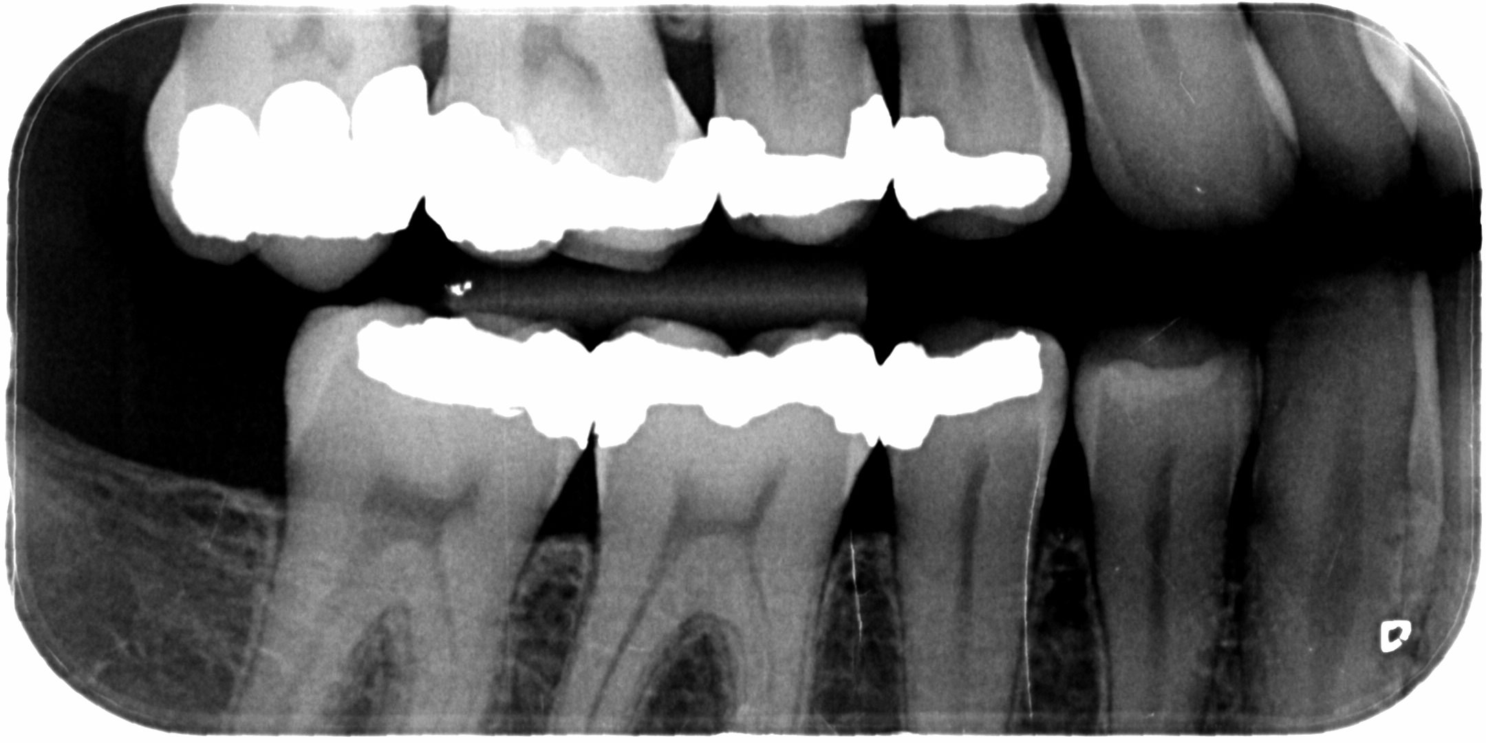 Kan geen gaatjes zien op de foto, maar zou er wel hebben?? Tandarts.nl Forum